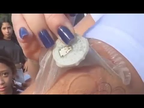 DIABETES: PROFESSORA É BARRADA EM PARQUE DE DIVERSÕES POR USAR SENSOR DE GLICOSE
