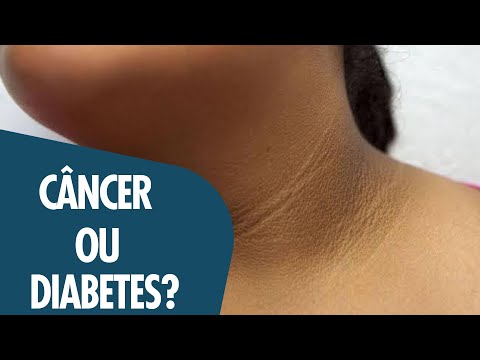 NÃO É SÓ UMA MANCHA: PODE SER DIABETES OU CÂNCER