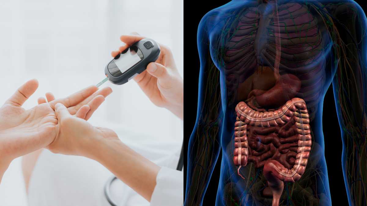 Substância para tratamento de intestino pode ajudar a evitar diabetes tipo 2