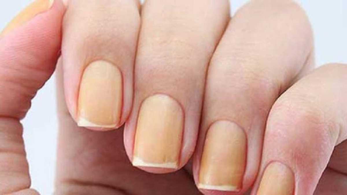 Unhas amarelas podem indicar glicose alta