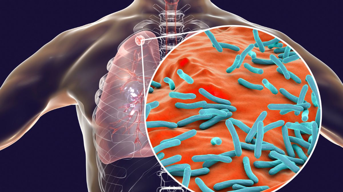 Turberculose afeta os pulmões de quem tem diabetes