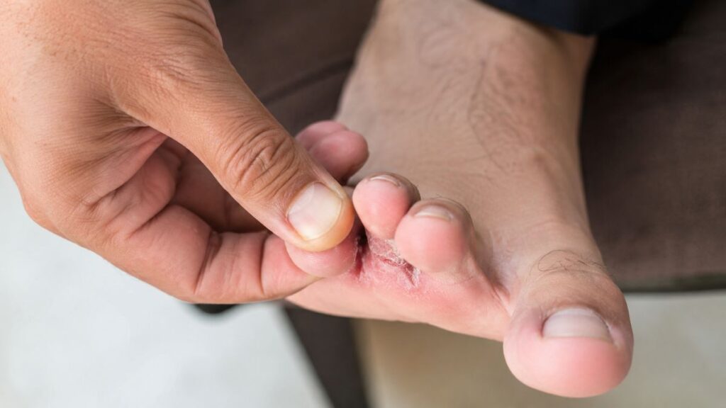 Especialista revela que micose entre os dedos pode evoluir para infecção em pessoas com diabetes Pessoa examinando micose entre os dedos do pé, condição que pode aumentar o risco de infecção em pessoas com diabetes.