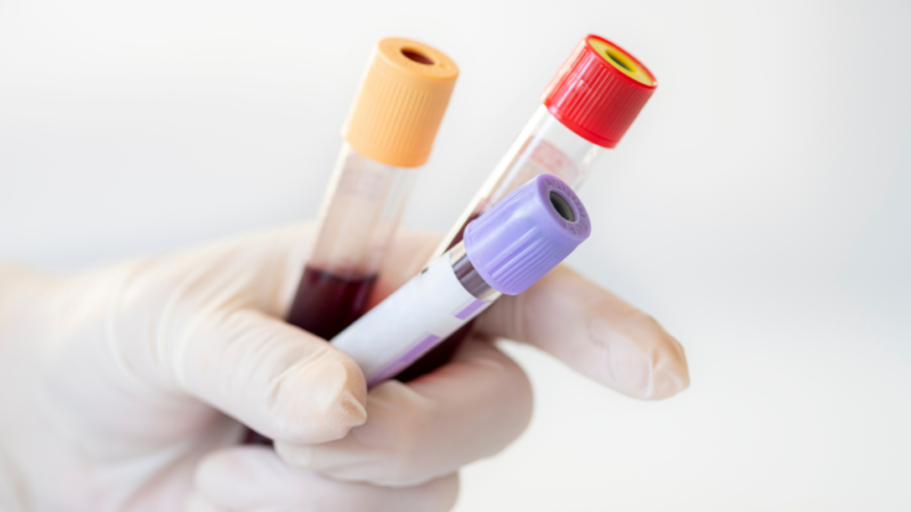 O que a hemoglobina glicada revela sobre os últimos meses de quem tem diabetes? Médica explica Exame de sangue em tubos coletados para análise de hemoglobina glicada