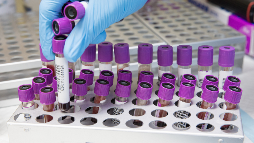 Hemoglobina glicada: qual o nível ideal e o que significa seu resultado? Profissional de laboratório manuseia tubos de sangue para exames de hemoglobina glicada, utilizados na avaliação do controle da glicose em pessoas com diabetes.